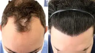 Injerto Capilar FUE (2810 Injertos NW IV Vertex) Dr. Juan Couto - FUEXPERT CLINIC - Madrid, España