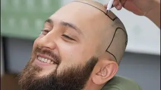 Real Hair Transplant Experience with Panorama Hair Turkey and Patient Reviews