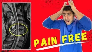 Chronic Neck pain recovery without surgery