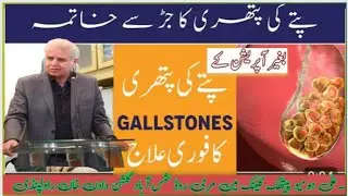Best remedy for Gall Bladder Stone (Cholelithiasis) !! Dr Ali Muhammad