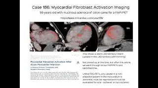 Case 186: Myocardial Fibroblast Activation Imaging