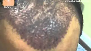 Charles Medical Group (41 yr-old FUG Hair Procedure 2263 Grafts) Video