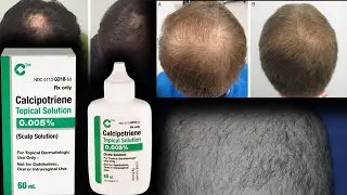Topical Vitamin D For Inflammatory Hair Loss