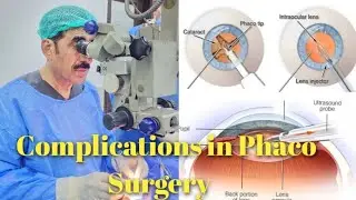 Eye | Complications in Phaco Surgery | Scleral Fixation | IOL Drop | Prof. Dr. Ejaz Javed Lak 