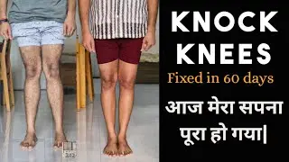 KNOCK KNEES FIXED IN 60 DAYS. Mr.anil explaining his journey.