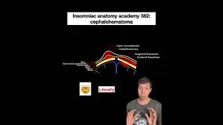 Insomniac anatomy academy 382: cephalohematoma #science #stem #anatomy #sciencefacts #babies