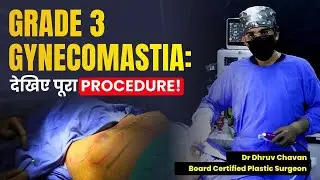 Grade 3 Gynecomastia Surgery: Step by Step Marking और Treatment Explained! | Dr DC, Pune