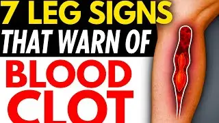 Over 60? 7 Leg Signs That Warn of a Blood Clot | Senior Health Tips