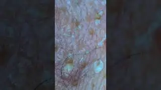 Blackheads Magnified