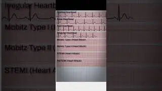 ECG changes in different types of Arrhythmia. #cardiology #medicine #study #motivation #medical