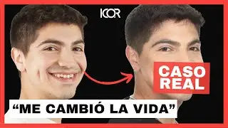 Testimonio Cirugía ortognática - Paciente Clase III (Mandíbula hacia delante)