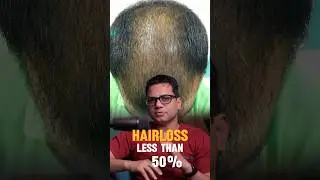 When to consider hair transplant? | Learn from the hair expert | Dr. Jangid