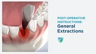Post-Operative Instructions: Extractions at Upstate Oral Surgery & Dental Implants, Watertown, NY