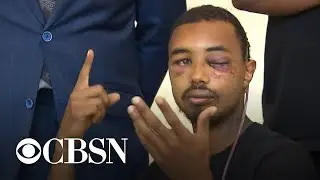 Dallas man says he was hit in eye with 