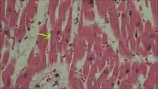 Lipofuscinose