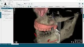 Demo NemoScan EN   2019 1