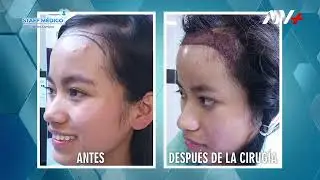 ✨Implante Capilar Mujer - Técnica DHI, Dr. Edwin Lazo👨🏻‍⚕️