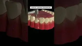 dental crown (cap) prepartion and placement on a compromised tooth. 3d animation