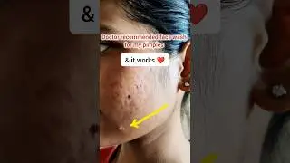 Doctor Recommend D Acne facewash is best for my acne prone skin and it works 😭#acneproneskin #pimple