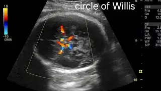 Normal 3rd Trimester Pregnancy Doppler: Uterine, Umbilical, MCA, and Ductus Venosus Explained