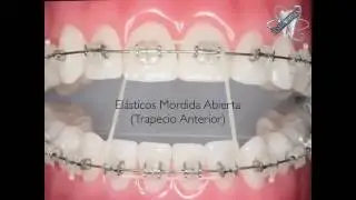 How to Wear Orthodontic Elastic Bands..كيفية وضع مطاط التقويم