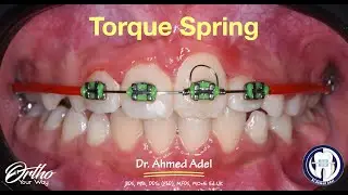 Torque spring of upper central incisor step by step by dr ahmed adel orthodontics