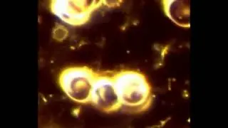 A Chronic Lyme disease patient's blood under a microscope