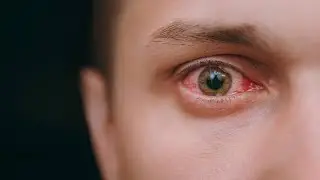 Normal Blink Rate | Dry eyes | Normal Blinking @eyecareoptom5506 #eye #dry eyes #dryeye  #blink