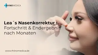 Leas Nasen-OP bei Rhinomedica | Ergebnisse nach 4 Monaten