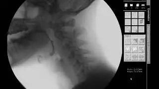Swallow Study - 13 mm Barium Tablet/Pill - Modified Barium Swallow Study (MBSS) Lateral View HD