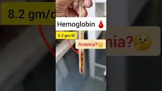 HEMOGLOBIN Estimation🩸-MBBS Pathology Practical(SAHLI'S Method) #mbbs #neet #shorts #pathology