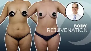 Female Body Rejuvenation Surgery | Dr. David Stoker | Los Angeles, CA