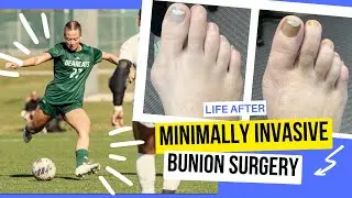 College Soccer Player's Experience With Bunion Surgery