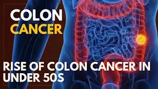 Unveiling the Rise of Colon Cancer in Under 50s: Understanding Its Growing Threat and Impact