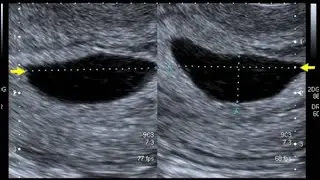 Mean Sac Diameter(MSD) Measurement - Ultrasound