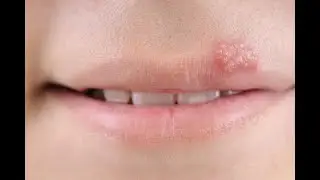 9 Rem&egrave;des de Grand M&egrave;re Pour Soigner un Bouton de Fi&egrave;vre Rapidement & Naturellement