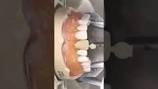 Adjustment of polycarbonate crown form before relining