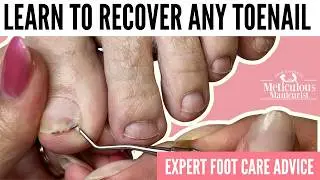 Toenail Growing on Top of Toenail? Damaged Nail Bed Recovery & Honest Pedicure Talk