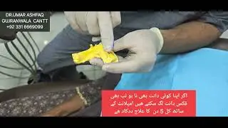 DENTAL IMPLANTS ALL LOWER FIX TEETH IN 5 DAYS