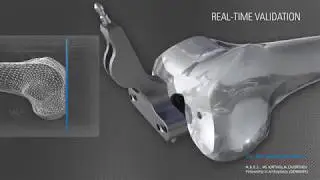 Knee Replacement Surgery  ExactechGPS&reg; Guided Personalized Surgery Edit