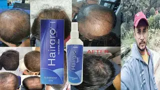fourrts hairgro serum | honest review