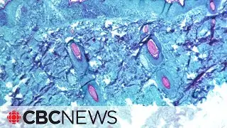 Monkeypox cases in Canada no reason for panic, says epidemiologist
