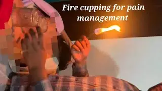 Cupping therapy for pain management #firecupping #cuppingtherapy #agnikarma #panchkarm #youtubevideo