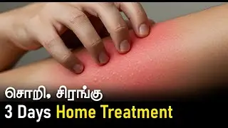 Scabies Treatment at Home in Tamil | Home Remedies for Cure Scabies | Natural Solution - INTAMIZH