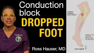 How to tell if dropped foot is caused by joint instability - Apply Hauser's Laws