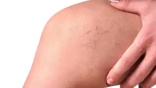 Laser Lounge Med Spa-  Laser Vein Removal