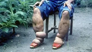 Lymphatic Filariasis (Elephantiasis)