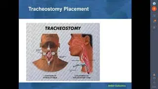 Mechanical Airway Mucus Clearance