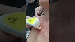 IPL SWT / traitement Erythrose couperose du d&eacute;collet&eacute;