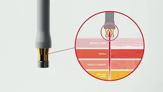 HIRO laser device - Technical presentation